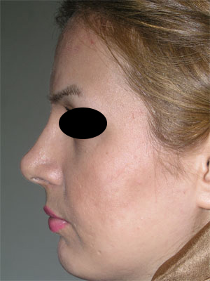 نمونه Chin cosmetic surgery کد 11