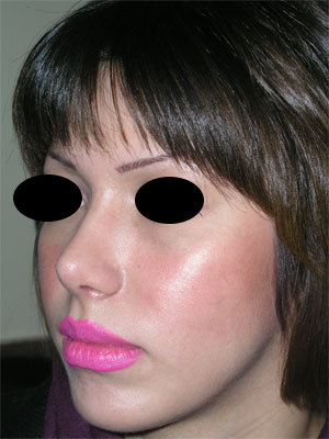 نمونه Chin cosmetic surgery کد 13