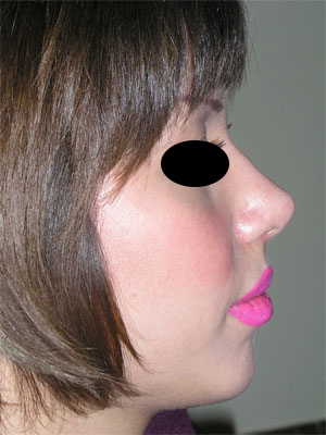 نمونه Chin cosmetic surgery کد 17