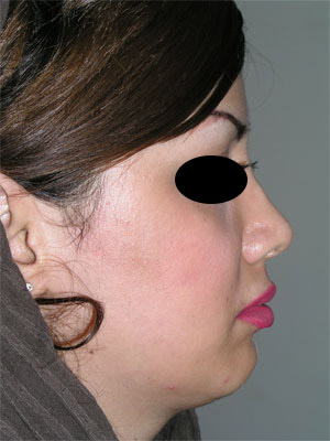 نمونه Chin cosmetic surgery کد 46