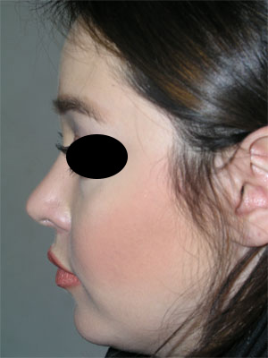 نمونه Cosmetic nose surgery کد 53