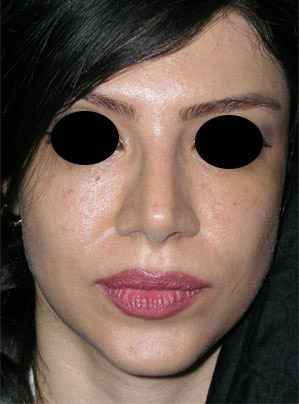 نمونه Cosmetic nose surgery کد 64