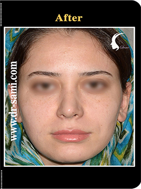 نمونه Cosmetic nose surgery کد n93-after